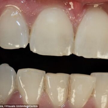 teeth Why having bad teeth could actually be good for you: People with a lot of cavities are a third LESS likely to develop mouth or throat cancer