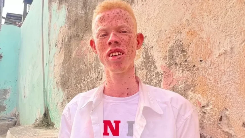 Somalis with albinism: Pelted with stones and raw eggs