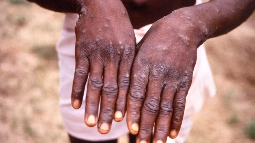 Kenya confirms second Mpox case